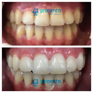 Blanqueamiento dental: tipos, precios y resultados