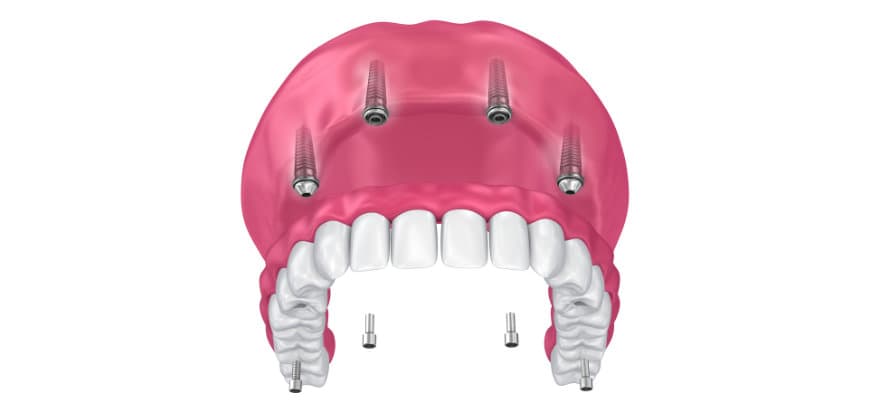 Las 5 preguntas que debes hacer antes de ponerte implantes dentales