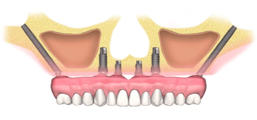 ¿Cuánto cuesta un implante dental en Málaga en 2026?