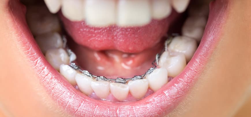 7 ventajas de la ortodoncia invisible frente a los brackets